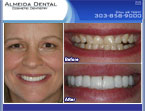 sample case study by Denver cosmetic dentist