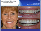 case study by Denver cosmetic dentist