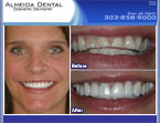Denver cosmetic dentist case study
