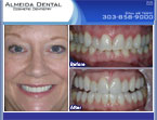porcelain veneers case study by cosmetic dentist Denver