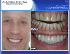 case study by Colorado cosmetic dentist with porcelain veneers