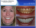 cosmetic dentist in Colorado porcelain veneers case study