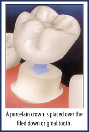 Almeida and Bell Aesthetic Dental Center Highlands Ranch, CO: Porcelain crown placement