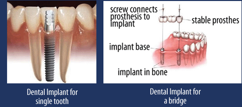 Highlands Ranch implant dentistry: Dental implant for single tooth, dental implant for a bridge